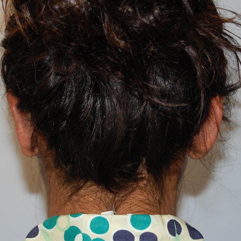 Ear Surgery Before & After Gallery - Patient 411771 - Image 6