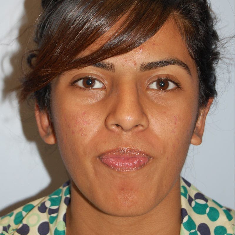 Ear Surgery Before & After Gallery - Patient 411771 - Image 2