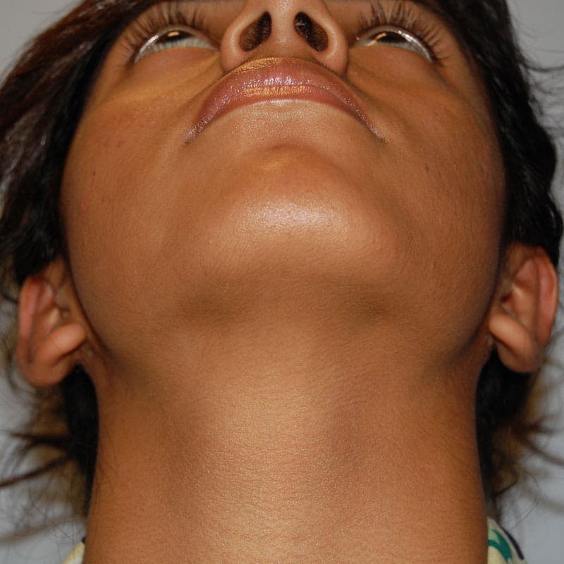 Ear Surgery Before & After Gallery - Patient 411771 - Image 4