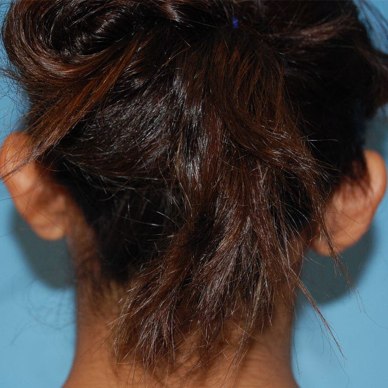 Ear Surgery Before & After Gallery - Patient 411771 - Image 5