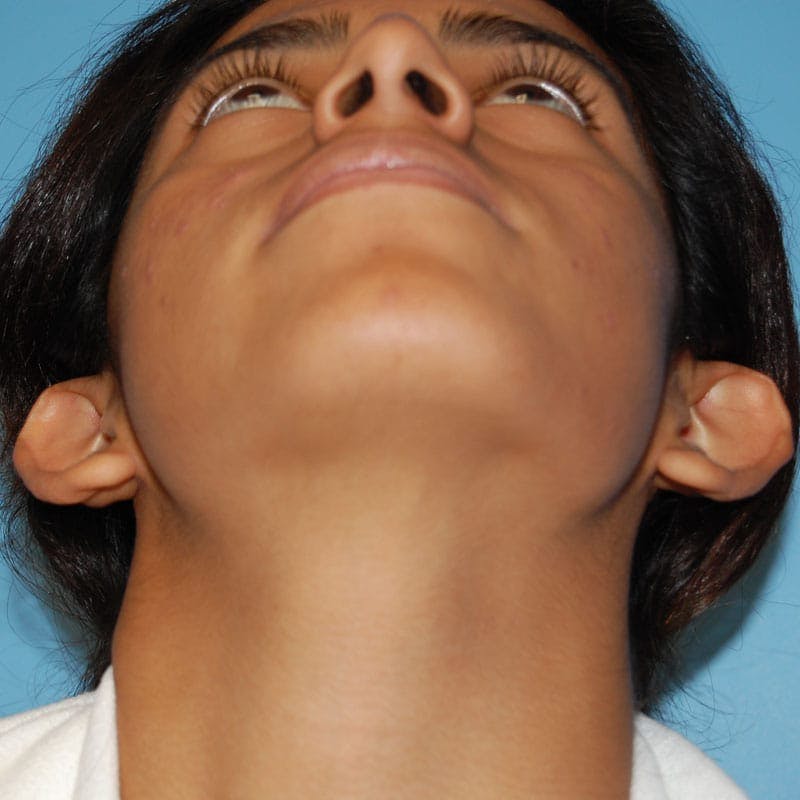 Ear Surgery Before & After Gallery - Patient 411771 - Image 3