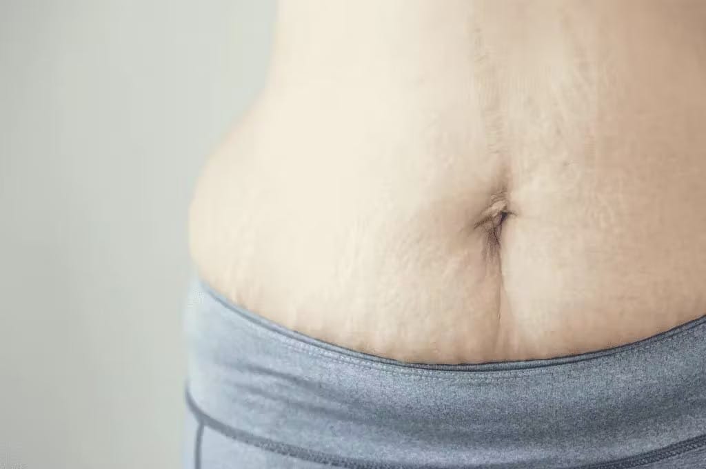 Your Mommy Makeover’s Non-Surgical Finishing Touch