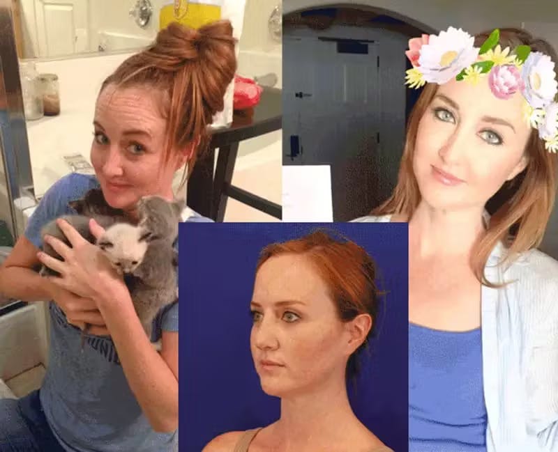 Snapchat Filters Inspire New Generation of Cosmetic Patients