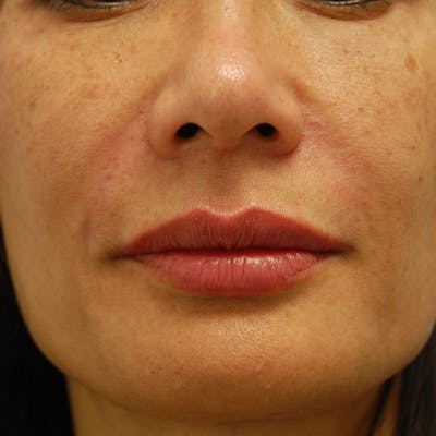 Lip Filler Before & After Gallery - Patient 219472 - Image 2
