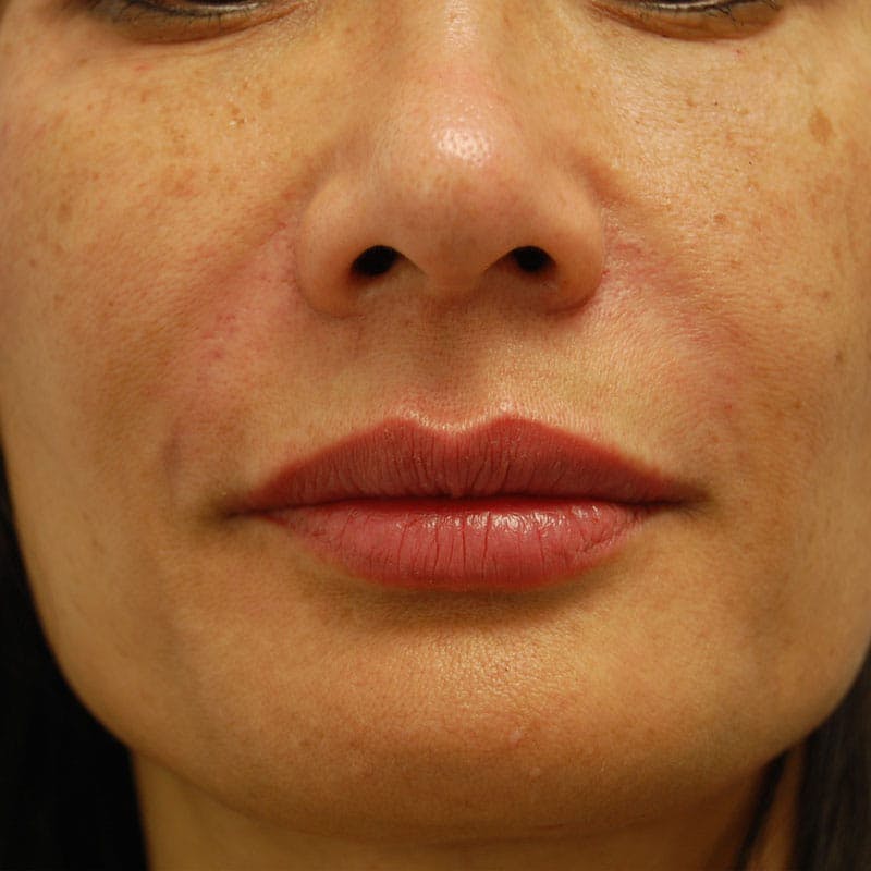 Lip Filler Before & After Gallery - Patient 219472 - Image 2