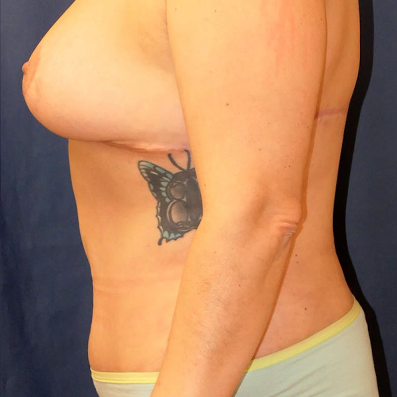 Tummy Tuck (Abdominoplasty) Before & After Gallery - Patient 344044 - Image 10