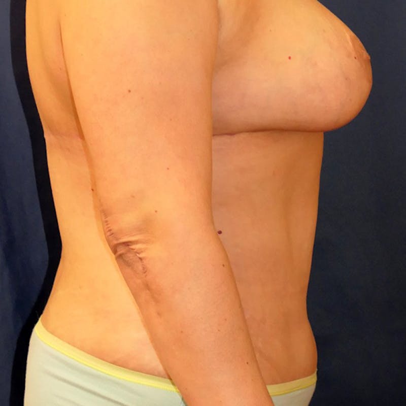 Tummy Tuck (Abdominoplasty) Before & After Gallery - Patient 344044 - Image 6
