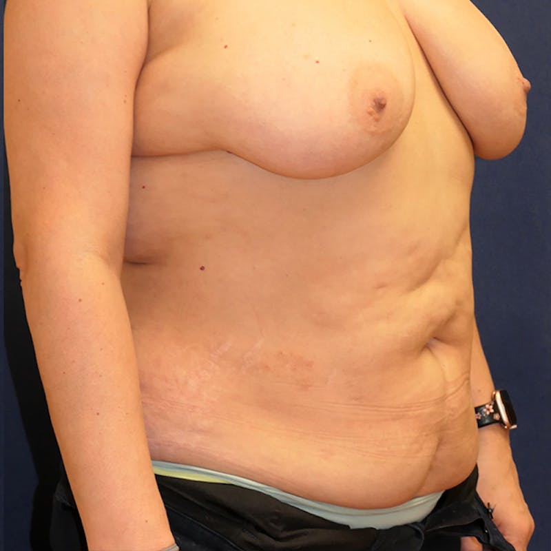 Tummy Tuck (Abdominoplasty) Before & After Gallery - Patient 344044 - Image 4