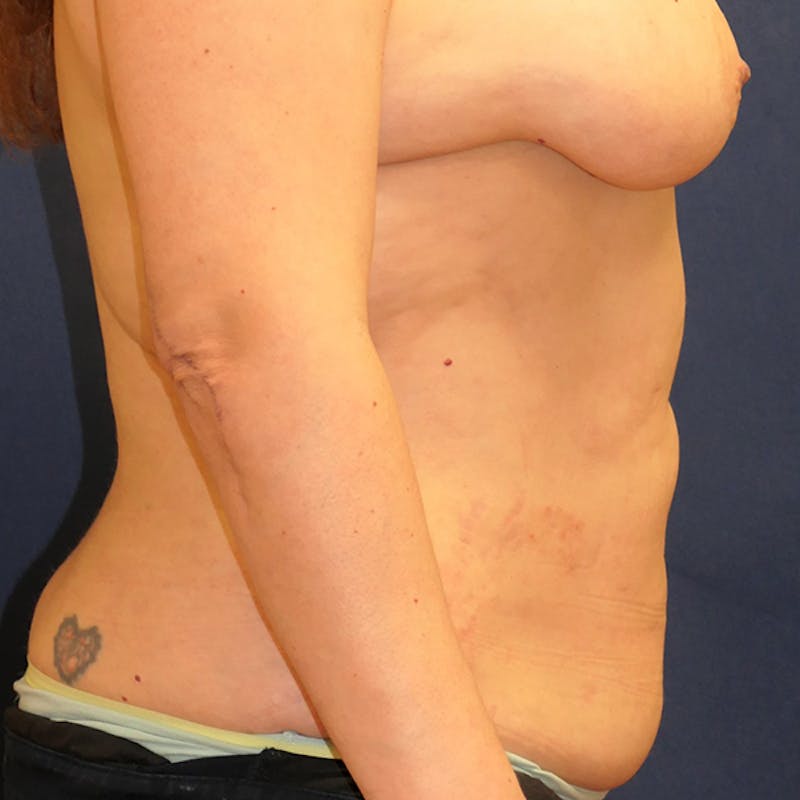 Tummy Tuck (Abdominoplasty) Before & After Gallery - Patient 344044 - Image 5