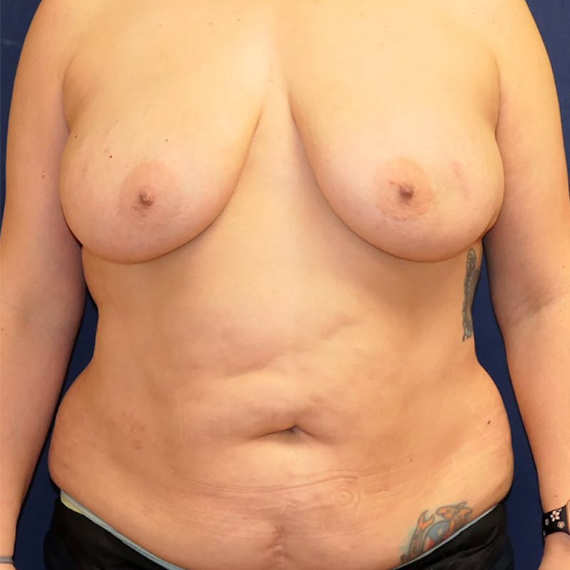 Tummy Tuck (Abdominoplasty) Before & After Gallery - Patient 344044 - Image 1