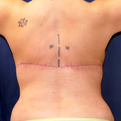 Back Lift Before & After Gallery - Patient 285005 - Image 2