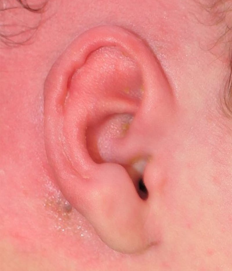 Ear Molding Before & After Gallery - Patient 278990 - Image 4