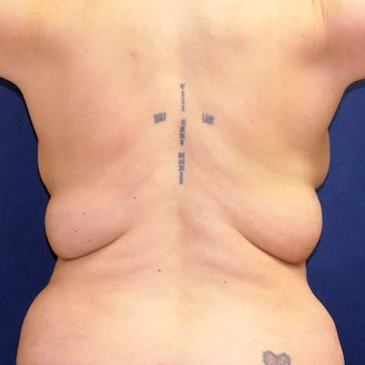 Back Lift Before & After Gallery - Patient 285005 - Image 1
