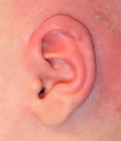 Ear Molding Before & After Gallery - Patient 278990 - Image 2