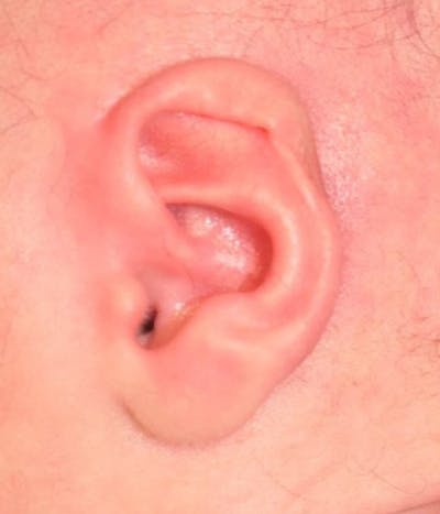 Ear Molding Before & After Gallery - Patient 278990 - Image 1