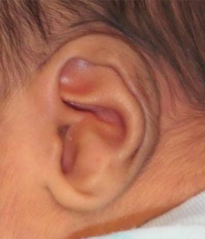 Ear Molding Before & After Gallery - Patient 376823 - Image 1