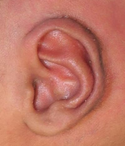 Ear Molding Before & After Gallery - Patient 376823 - Image 2