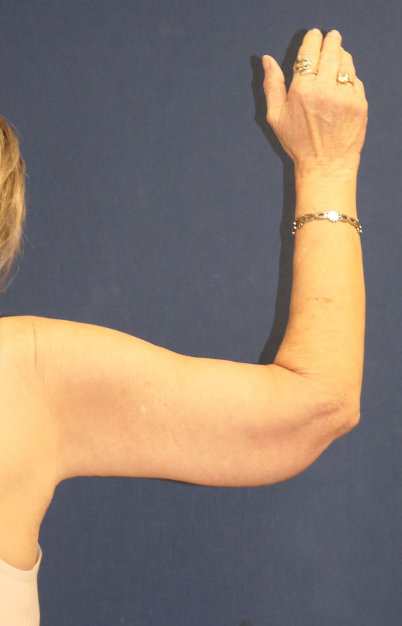 Arm Lift (Brachioplasty) Before & After Gallery - Patient 141837 - Image 2