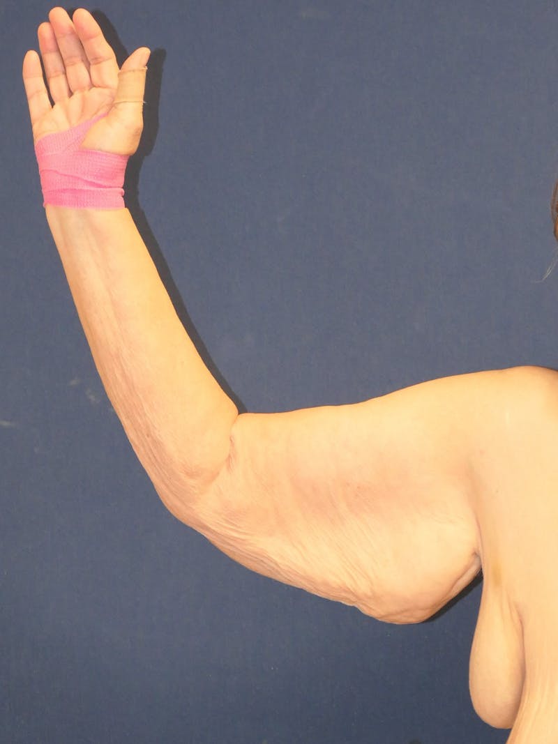 Arm Lift (Brachioplasty) Before & After Gallery - Patient 141837 - Image 7