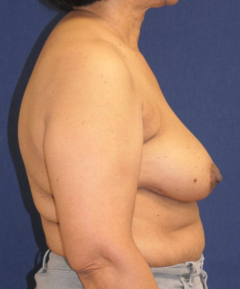 Breast Reconstruction with Implants Only Before & After Gallery - Patient 225381 - Image 5