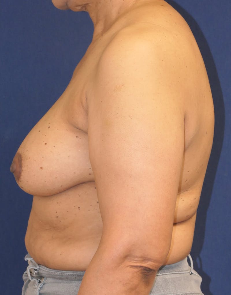 Breast Reconstruction with Implants Only Before & After Gallery - Patient 225381 - Image 9