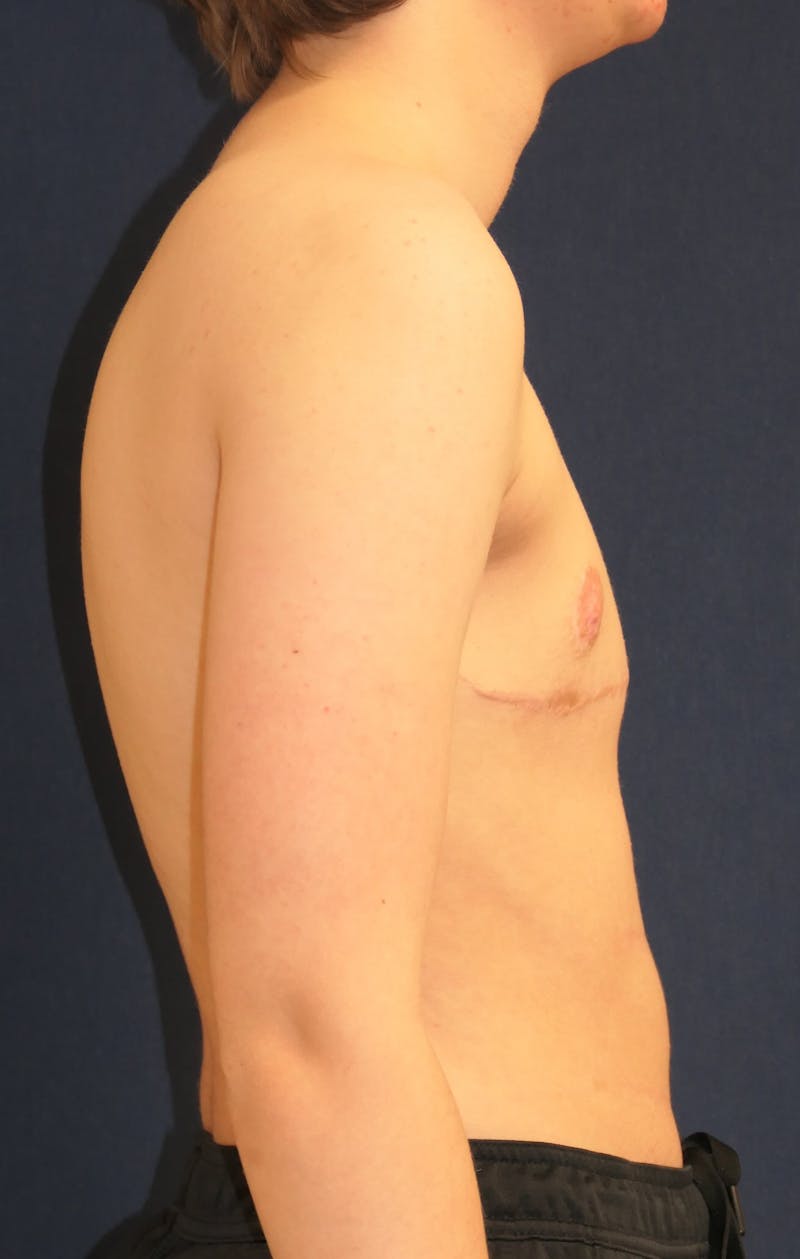 Masculinizing Surgery Before & After Gallery - Patient 279044 - Image 4