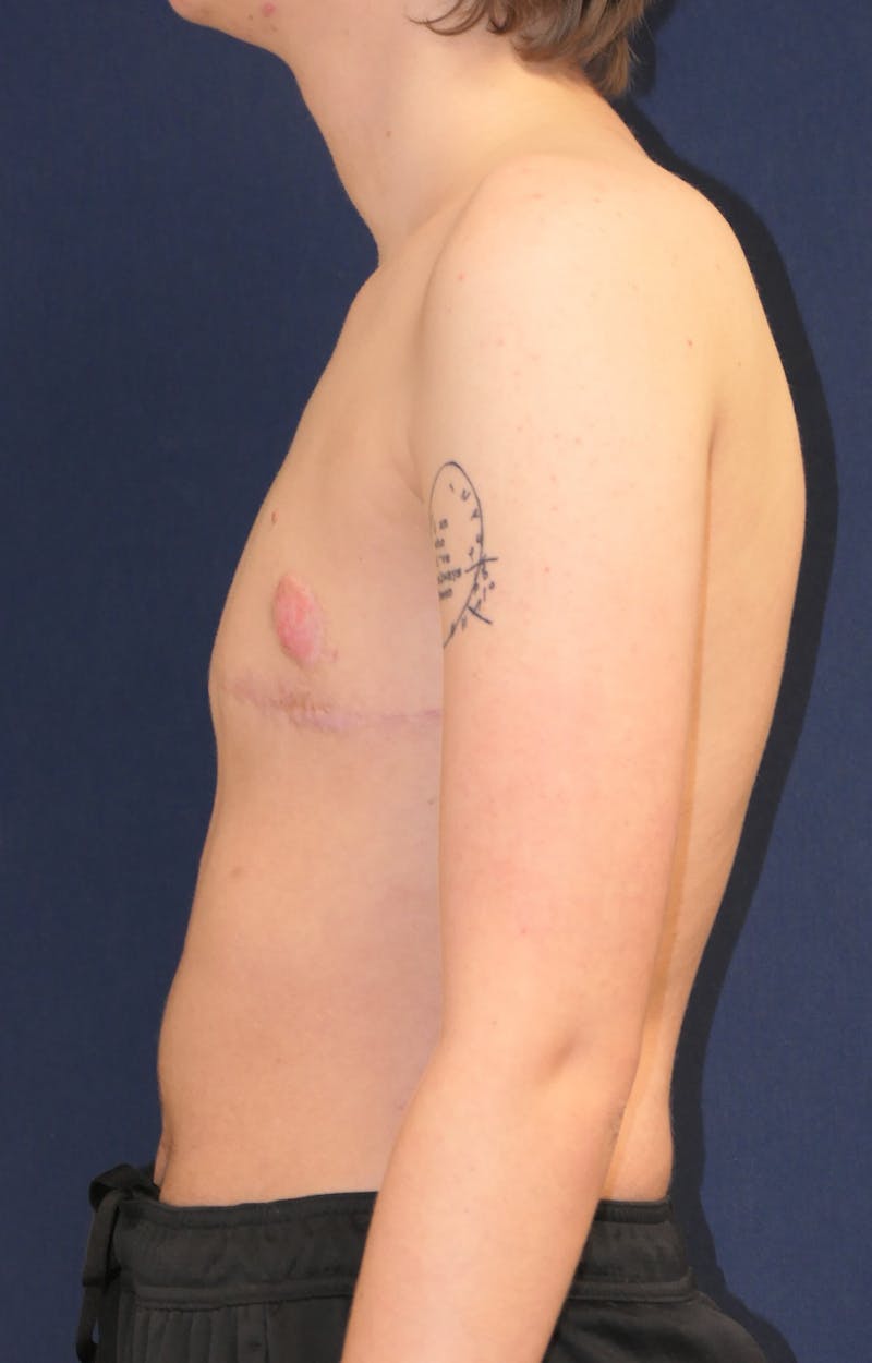 Masculinizing Surgery Before & After Gallery - Patient 279044 - Image 6