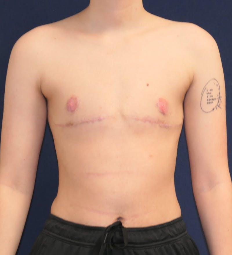Masculinizing Surgery Before & After Gallery - Patient 279044 - Image 2