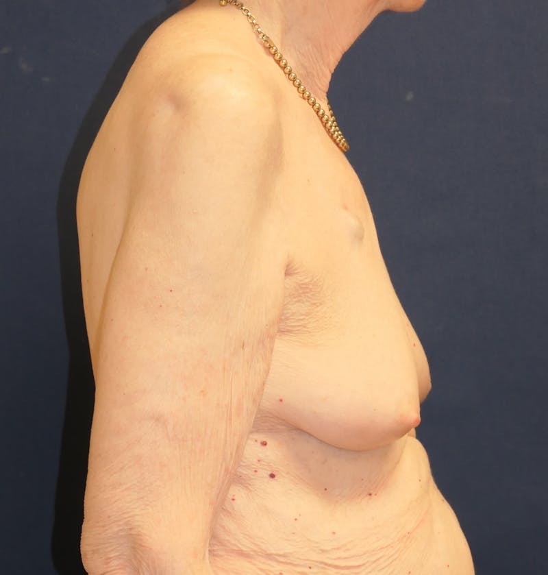 Breast Reconstruction with Implants Only Before & After Gallery - Patient 273554 - Image 5