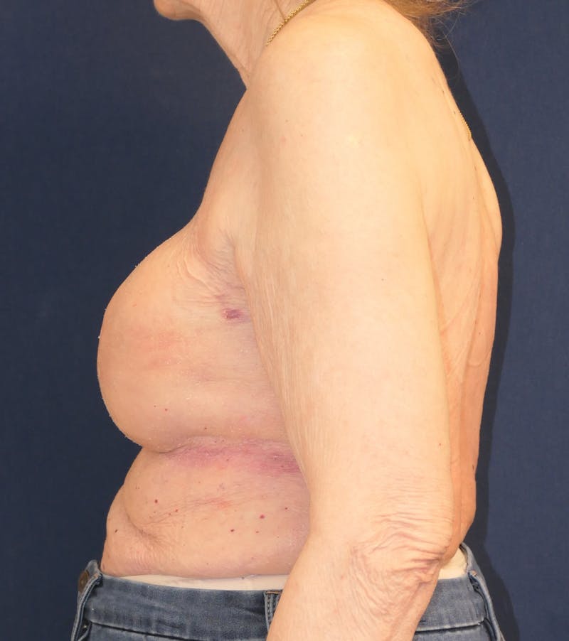Breast Reconstruction with Implants Only Before & After Gallery - Patient 273554 - Image 10