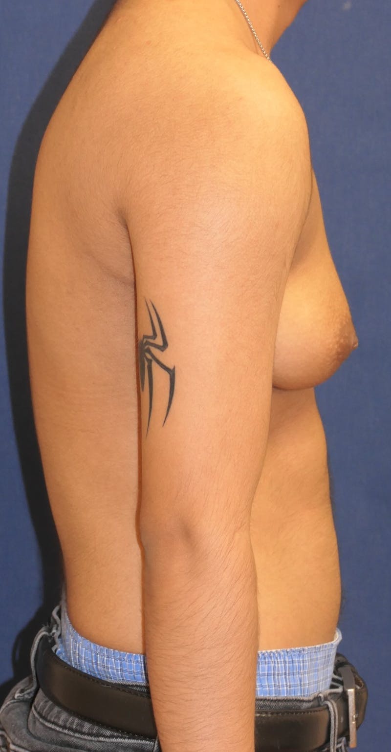 Masculinizing Surgery Before & After Gallery - Patient 230188 - Image 3