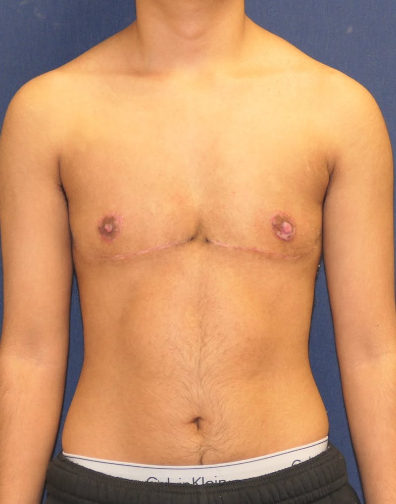 Masculinizing Surgery Before & After Gallery - Patient 230188 - Image 2