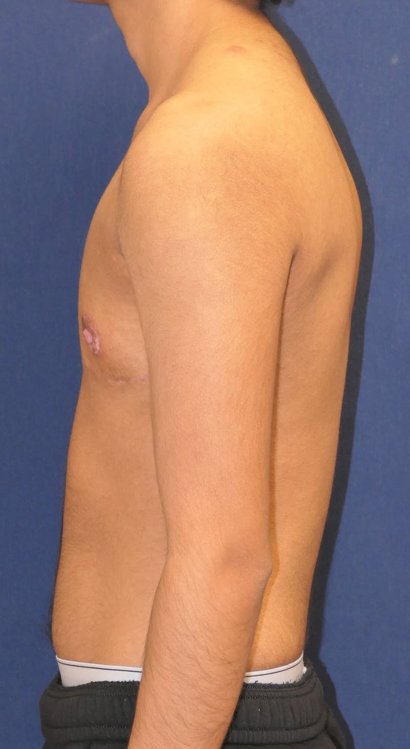 Masculinizing Surgery Before & After Gallery - Patient 230188 - Image 6