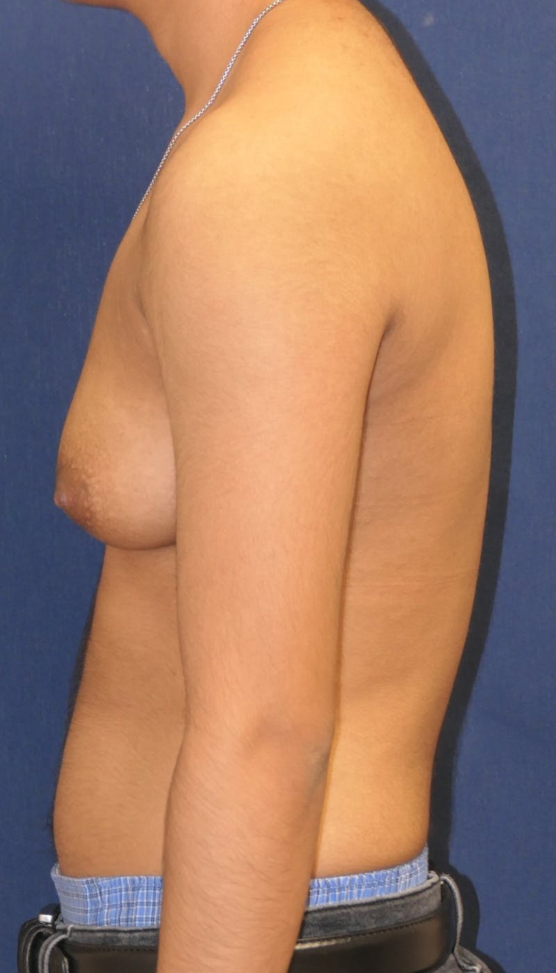 Masculinizing Surgery Before & After Gallery - Patient 230188 - Image 5