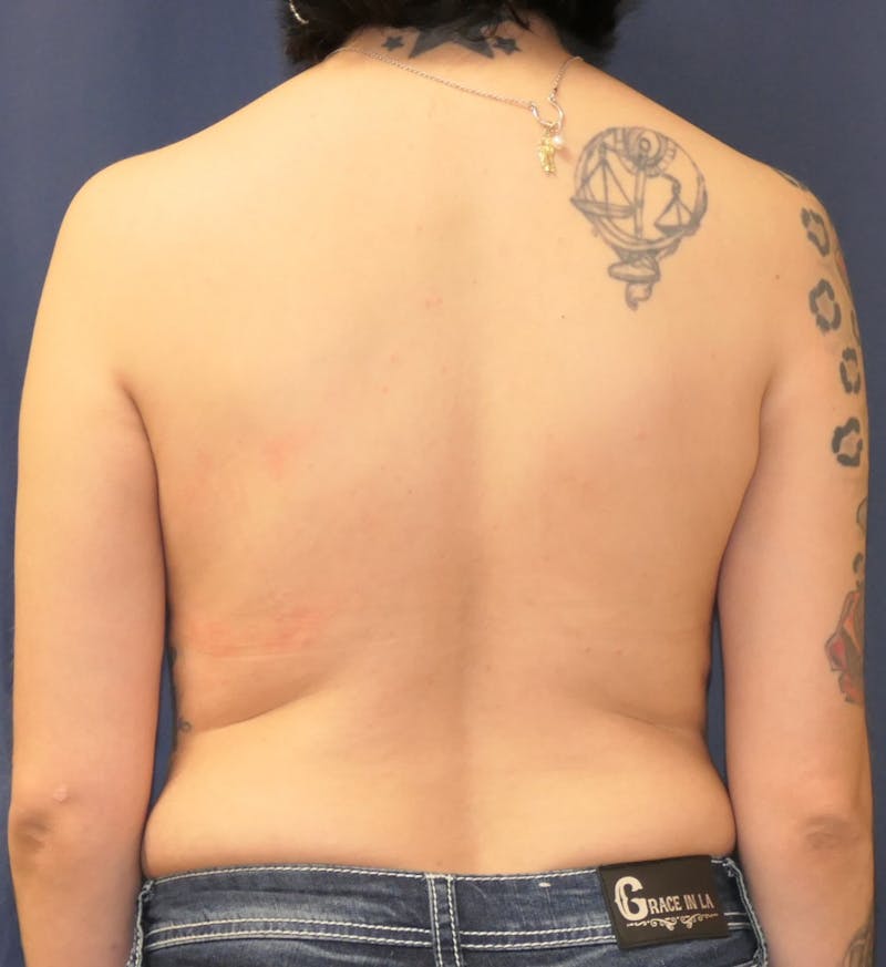 Breast Reconstruction with Autologous Tissue Before & After Gallery - Patient 307436 - Image 11
