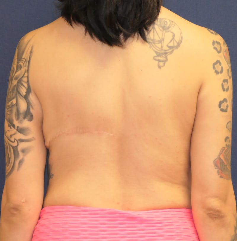 Breast Reconstruction with Autologous Tissue Before & After Gallery - Patient 307436 - Image 12