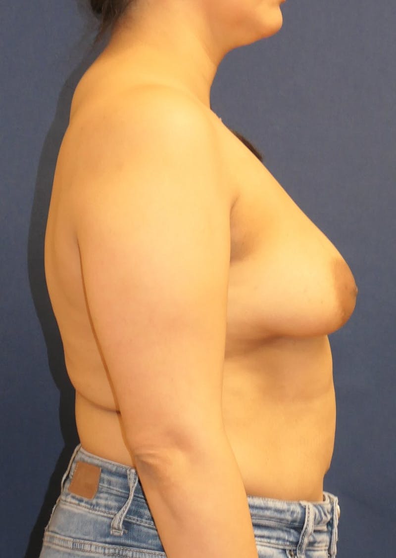 Breast Reconstruction with Implants Only Before & After Gallery - Patient 303264 - Image 5