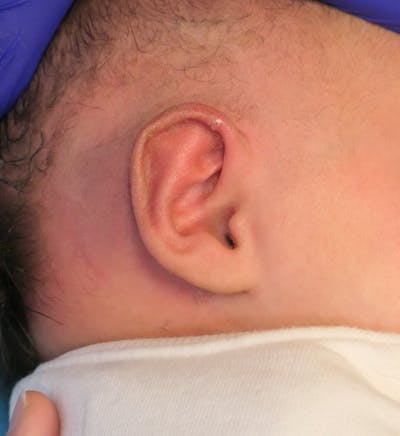 Pediatric Ear Molding Before & After Gallery - Patient 189603 - Image 2