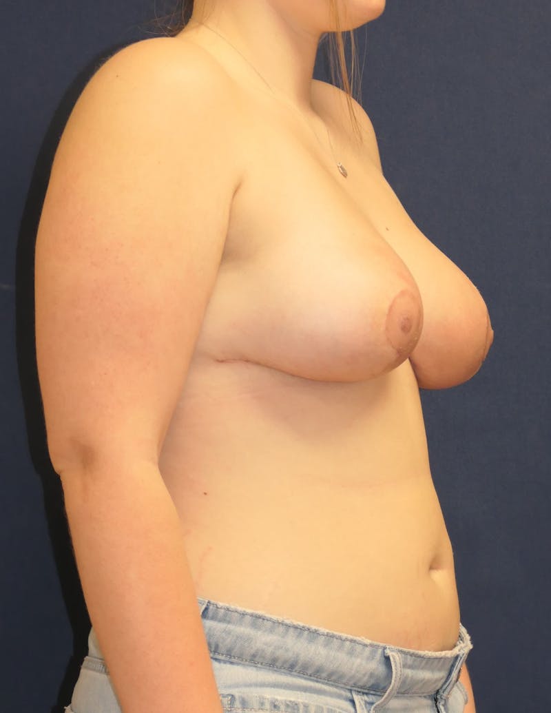 Breast Lift Before & After Gallery - Patient 311029 - Image 4