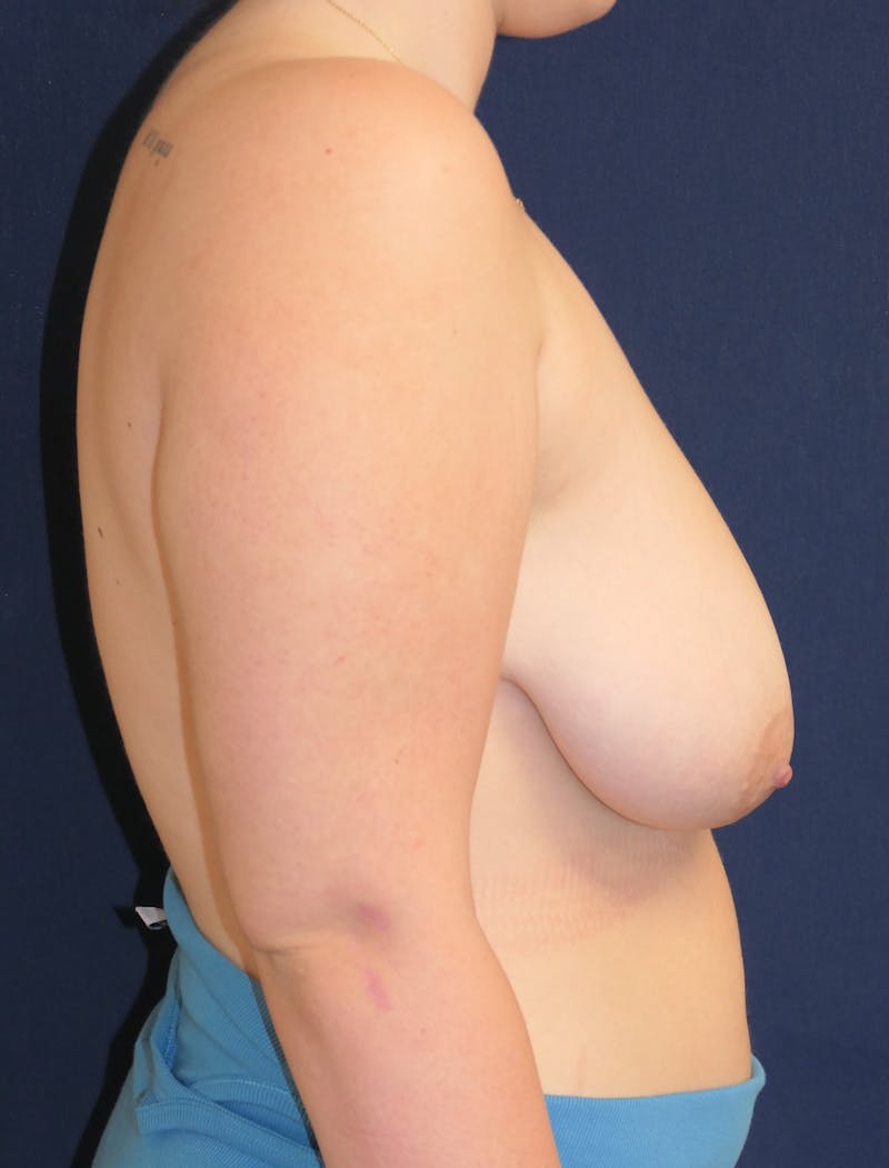 Breast Lift Before & After Gallery - Patient 311029 - Image 5