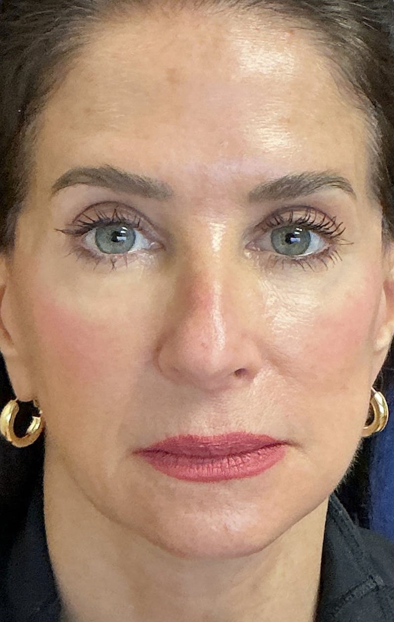 Facelift Before & After Gallery - Patient 268612 - Image 6