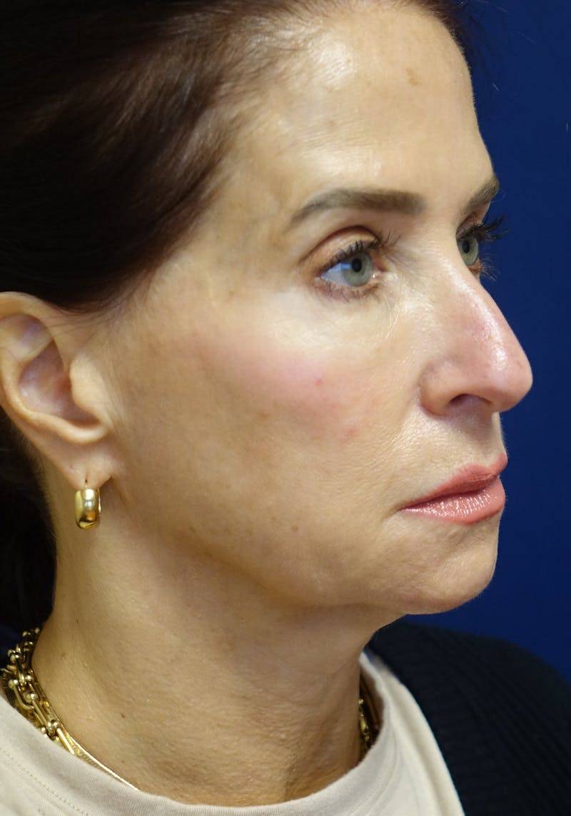 Facelift Before & After Gallery - Patient 268612 - Image 3