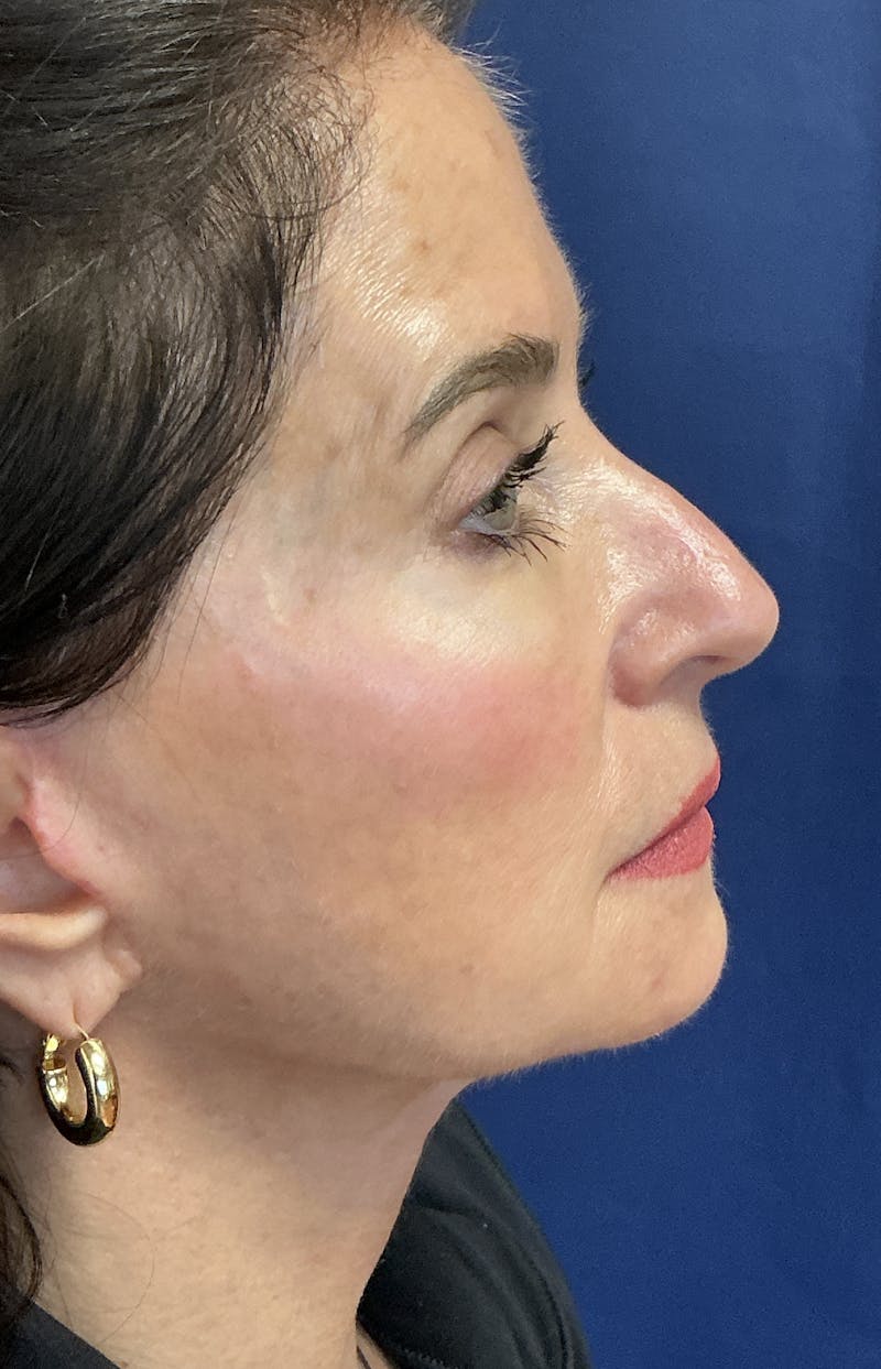 Facelift Before & After Gallery - Patient 268612 - Image 2