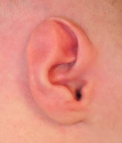 Ear Molding Before & After Gallery - Patient 203658 - Image 1