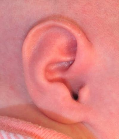 Ear Molding Before & After Gallery - Patient 203658 - Image 2
