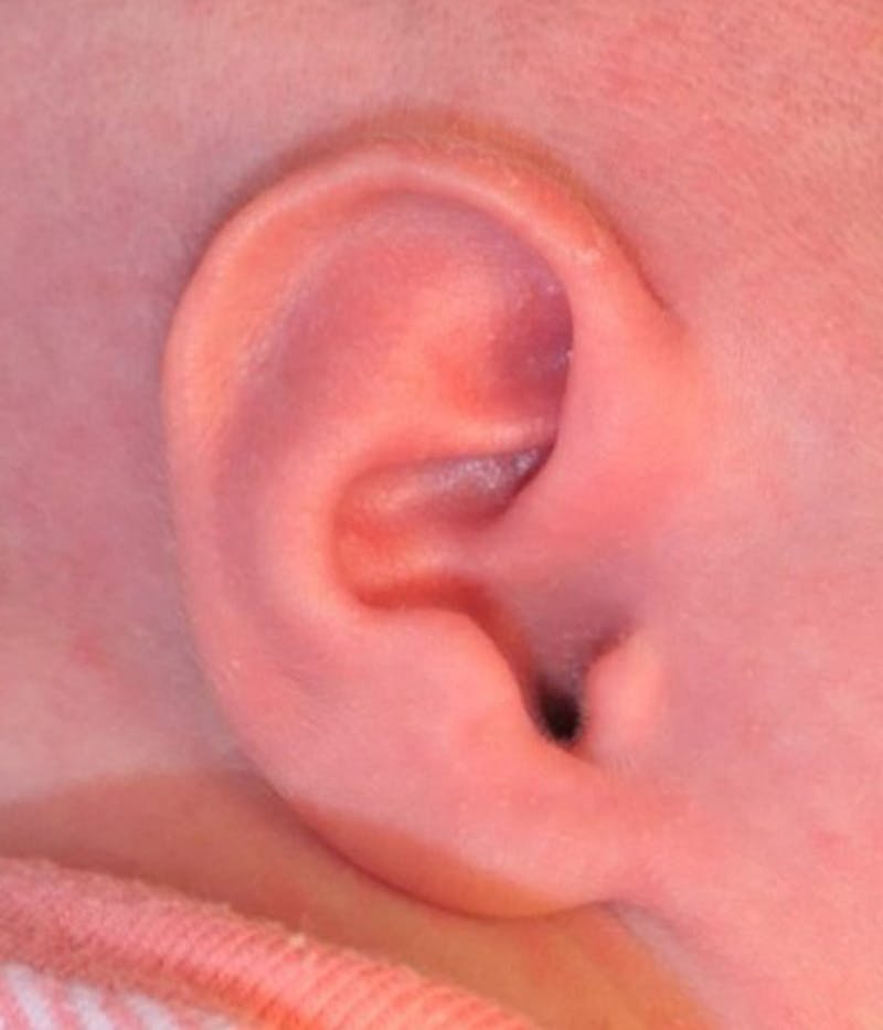 Ear Molding Before & After Gallery - Patient 203658 - Image 2
