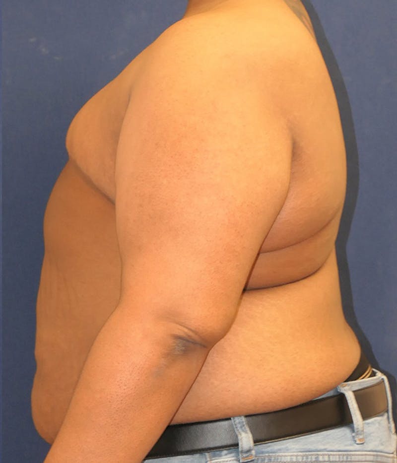 Masculinizing Surgery Before & After Gallery - Patient 326271 - Image 6