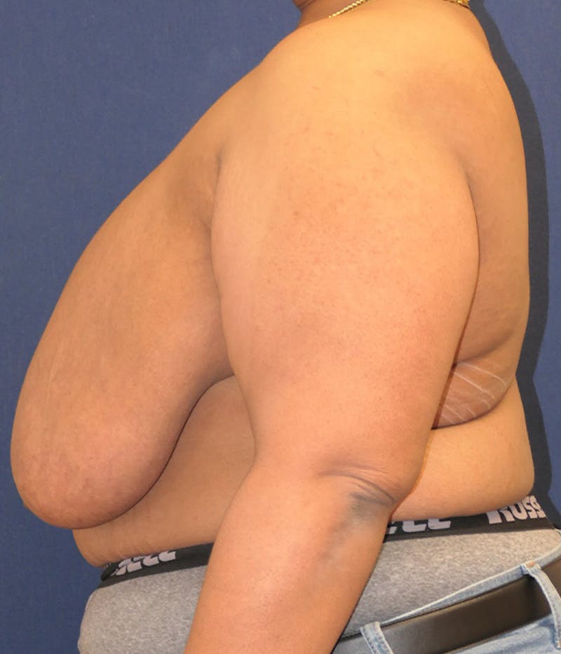 Masculinizing Surgery Before & After Gallery - Patient 326271 - Image 5