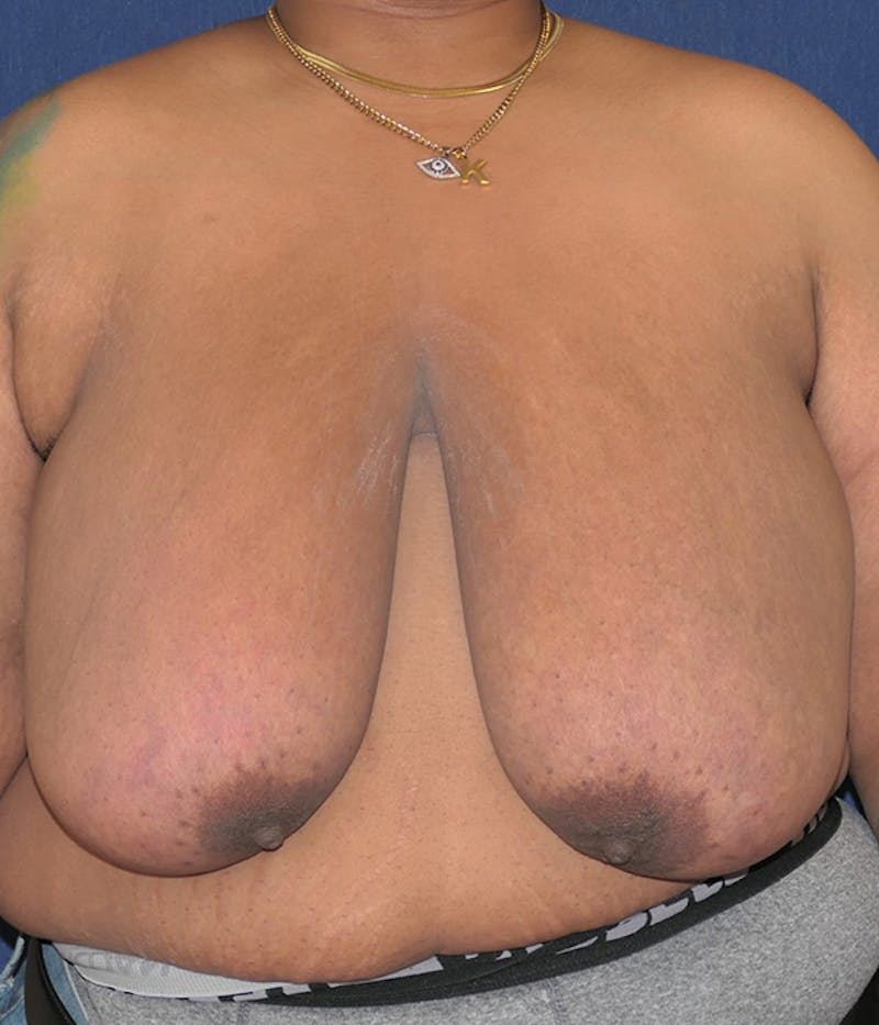 Masculinizing Surgery Before & After Gallery - Patient 326271 - Image 1
