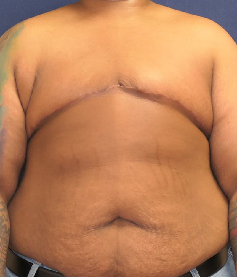 Masculinizing Surgery Before & After Gallery - Patient 326271 - Image 2